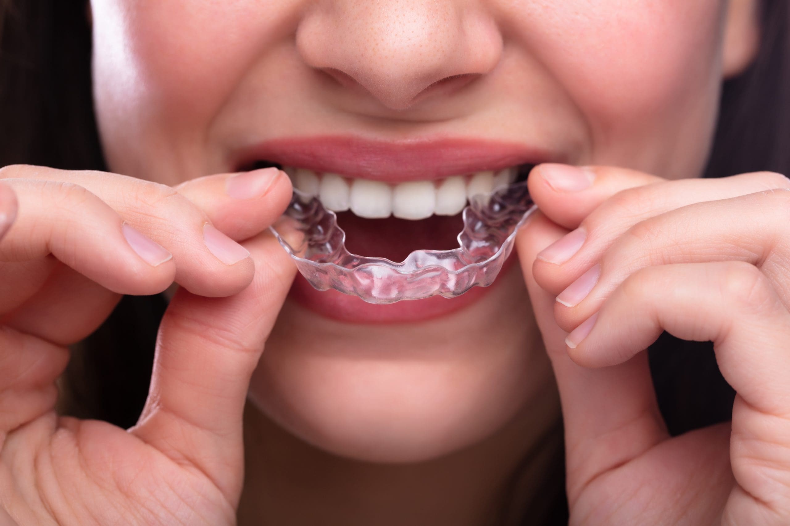 Aurora Invisalign Clear Aligners near me